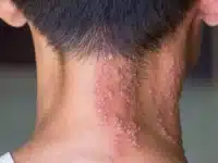 Herpes zoster