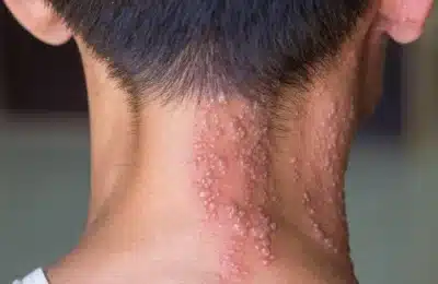 Herpes zoster