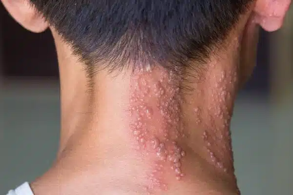 Herpes zoster